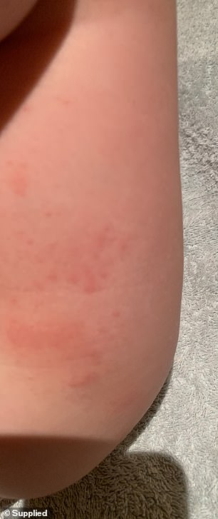 The bites started to appear on her legs (pictured)