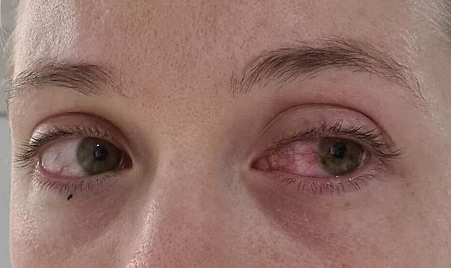 Ms Pretorius (above) thought she was suffering conjunctivitis before she was diagnosed as one of Perth's few tattoo-associated uveitis patients