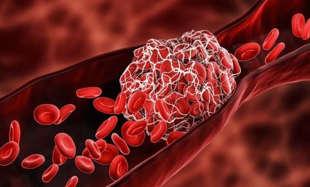 Self-assessment for deep vein thrombosis, and 5 preventative measures to help dissolve blood clots in a non-emergency situation